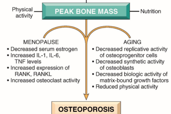 Key Factors in Osteoporosis Prevention