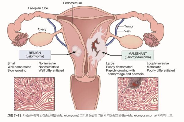 Difference Between Tumors and Cancer